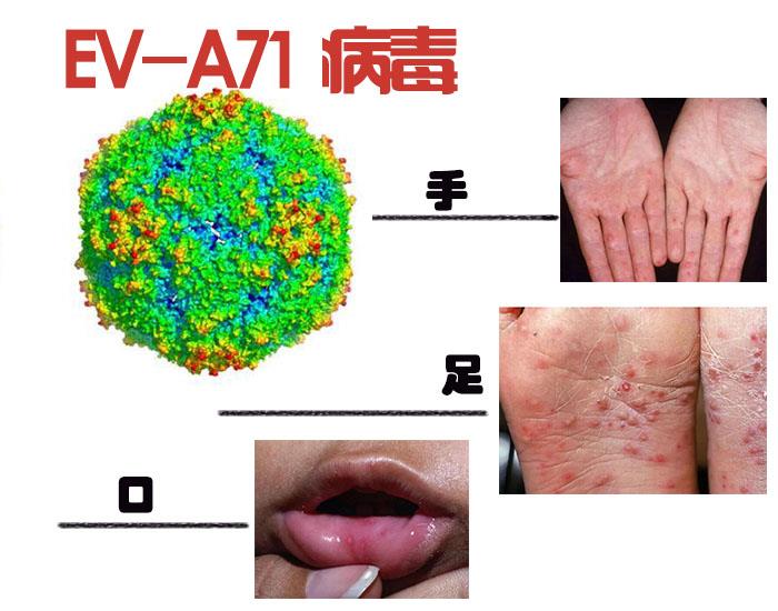 手足口病高峰期又来了,预防只需四招